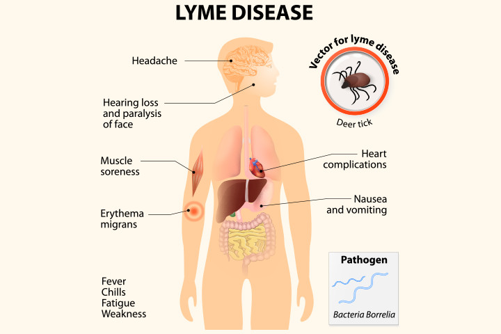 frank-magliochetti-report-symptoms-of-lyme-disease